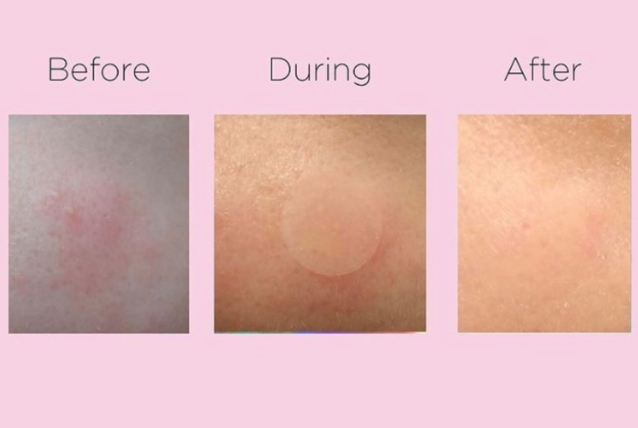 Truvi Beauty Blemish Spot Treatment